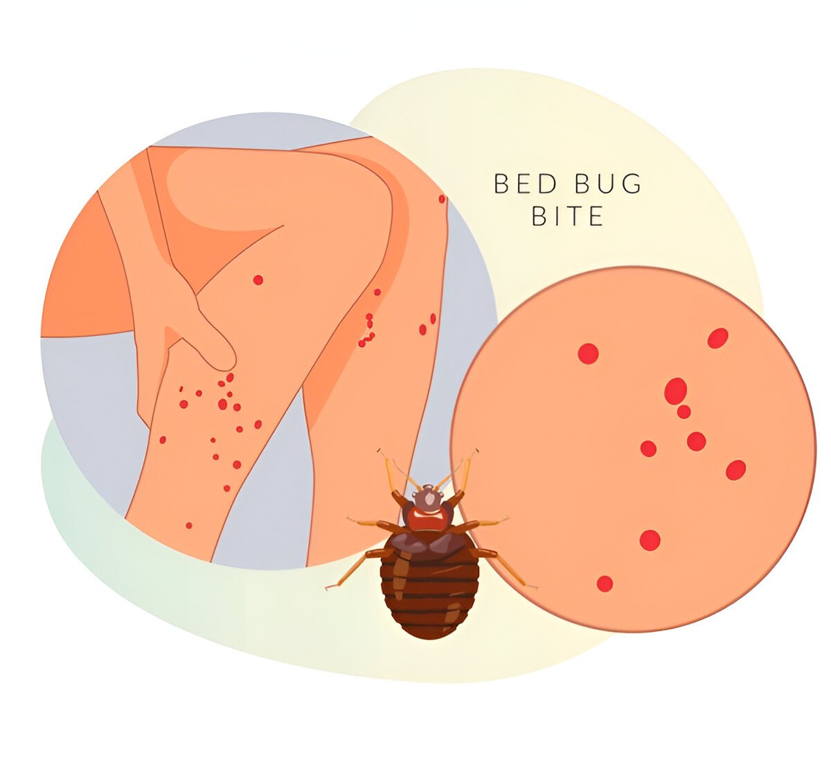 Mosquito Bites vs Bed Bug Bites