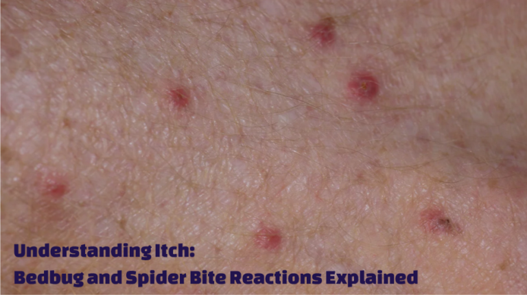 Bedbug and Spider Bite Reactions Explained