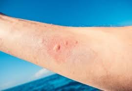 How to Neutralize a Jellyfish Sting