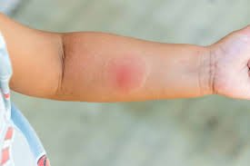 Allergic Reaction to Spider Bites: Symptoms, Causes & Treatment Allergic Reaction to Spider Bites