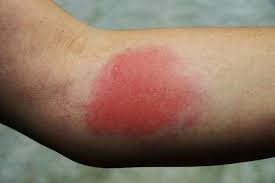 Allergic Reaction to Wasp Sting