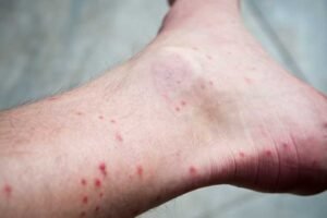 Allergic Reactions to Flea Bites