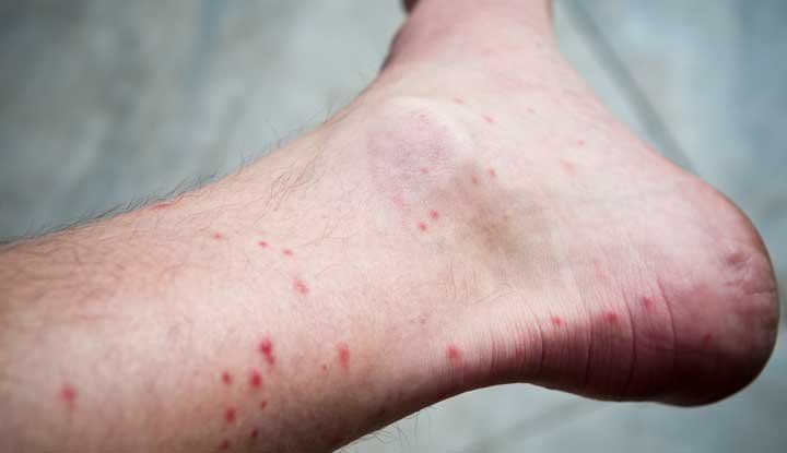 Allergic Reactions to Flea Bites