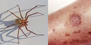 Antibiotics for Spider Bites: When Are They Needed? Antibiotics for Spider Bites