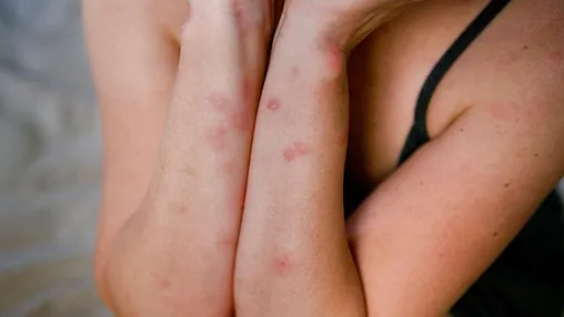 Bed Bug Bite Care Routine: Relief, Treatment, and Prevention Tips Bed Bug Bite Care Routine