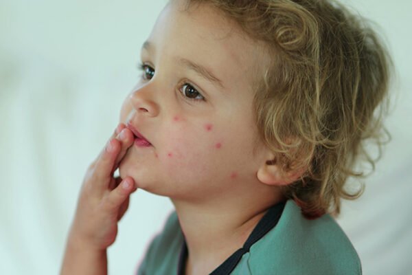 Bed Bug Bites on Face: Identification, Causes & Treatment Bed Bug Bites on Face
