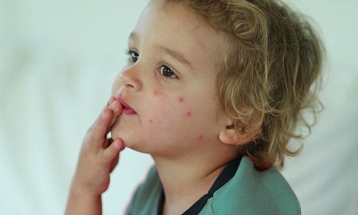 Bed Bug Bite Symptoms in Children