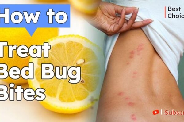 Bed Bug Rash Treatment: Fast Relief & Prevention Tips Bed Bug Rash Treatment