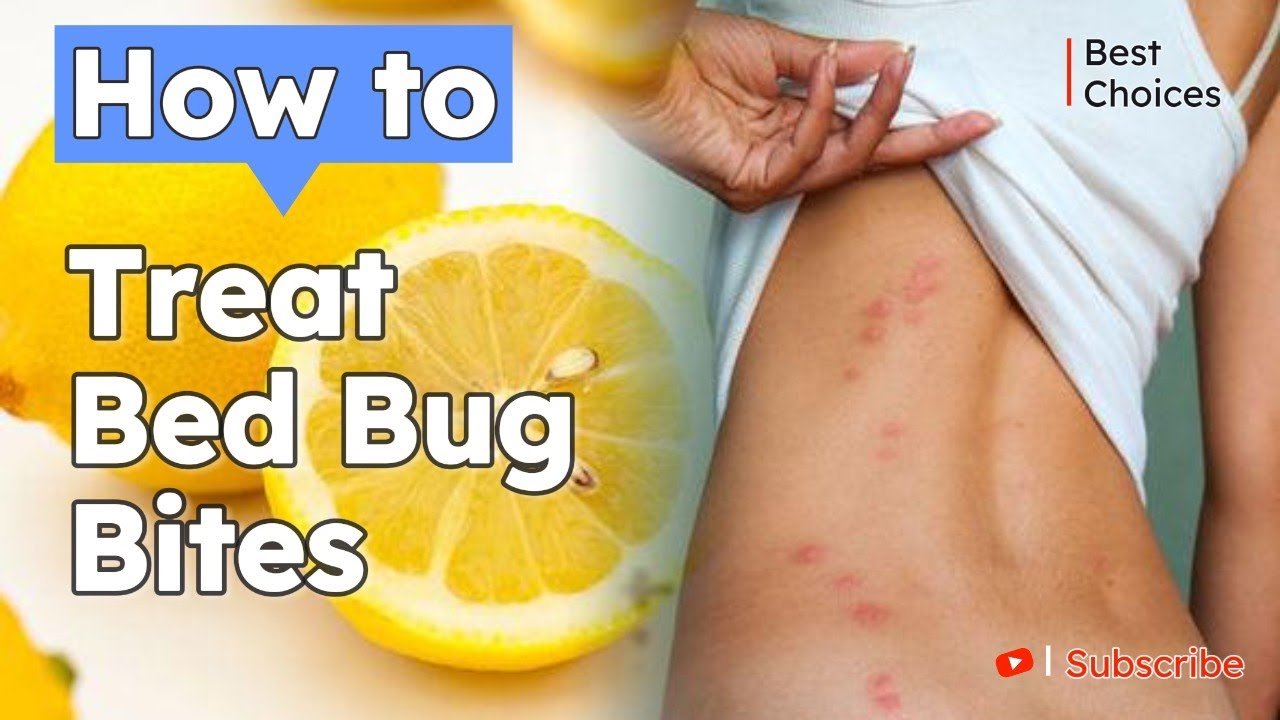 Bed Bug Rash Treatment