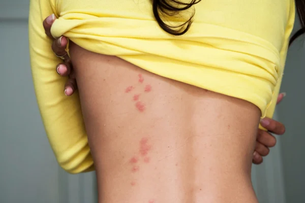 Best Ointment for Bed Bug Bites: Top Treatments to Soothe Itching & Swelling Best Ointment for Bed Bug Bites