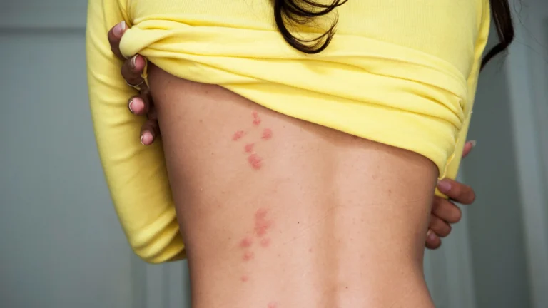 Best Ointment for Bed Bug Bites