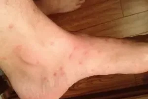 Flea Bite Scars Treatment