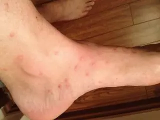 Flea Bite Scars Treatment: Effective Ways to Heal Your Skin Flea Bite Scars Treatment