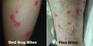 Flea Bites vs Bed Bug Bites