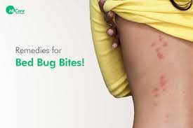 Home Remedies for Bed Bug Bites: Natural Ways to Soothe Itchy Skin Home Remedies for Bed Bug Bites