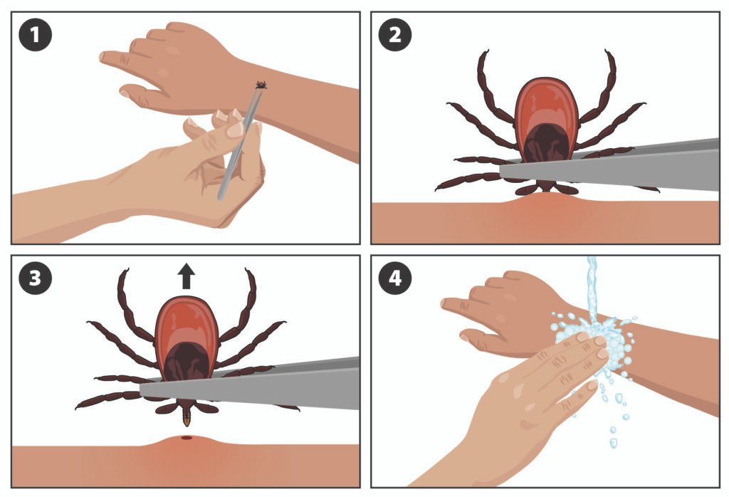 How to Remove Ticks Safely: Step-by-Step Guide for Humans and Pets How to Remove Ticks Safely