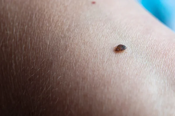How to Tell If Bites Are From Bed Bugs: Signs & Identification Tips How to Tell If Bites Are From Bed Bugs