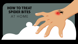How to Treat a Spider Bite: Step-by-Step Relief & Care Guide How to Treat a Spider Bite