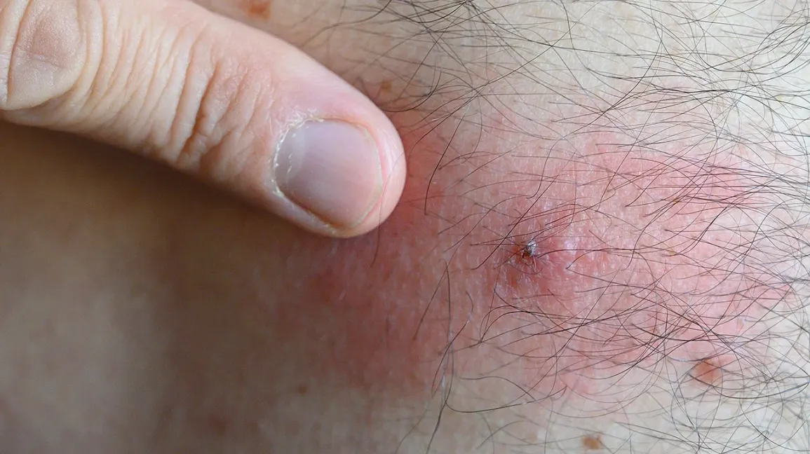 Improving Wellness After Insect Contact