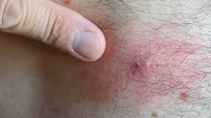 Infected Spider Bite Care: How to Treat and Prevent Complications Infected Spider Bite Care