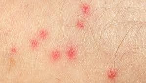 Mosquito Bite Blister Treatment
