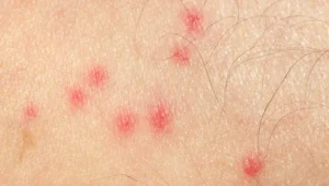 Why Do Mosquito Bites Itch More at Night? 5 Scientific Reasons & Relief Tips Why Do Mosquito Bites Itch More at Night