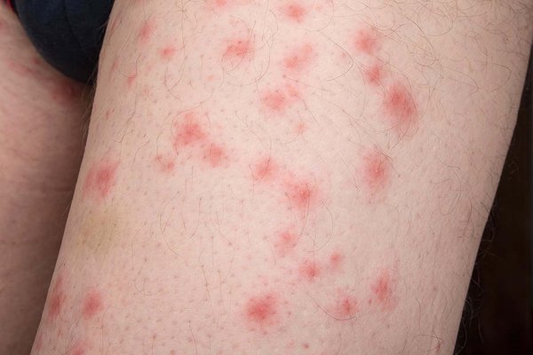 Pictures of Bed Bug Bites