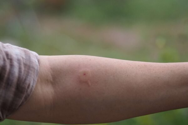 Signs of Severe Wasp Sting