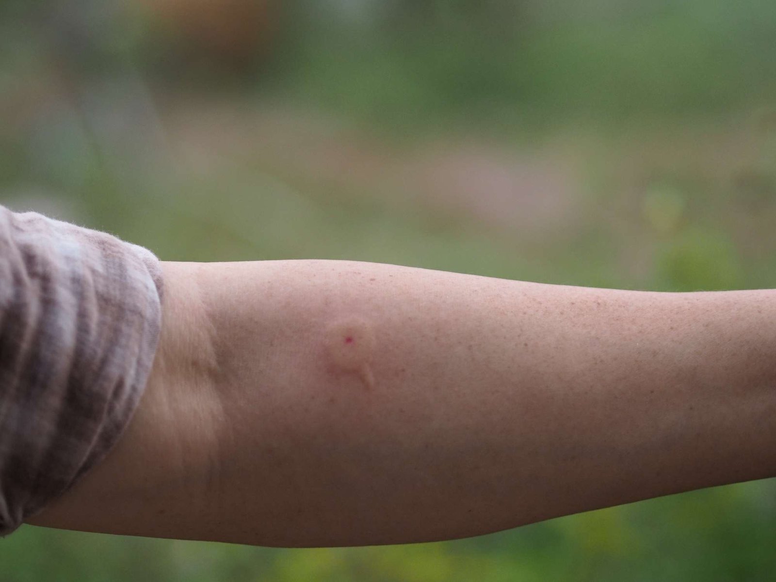Signs of Severe Wasp Sting