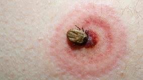 Signs of Tick Bite Infection: How to Identify and Treat It Effectively Signs of Tick Bite Infection