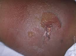 Spider Bite Healing Stages: How to Identify, Treat, and Recover Quickly Spider Bite Healing Stages