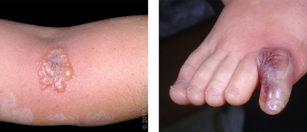 Spider Bite Symptoms and Treatment