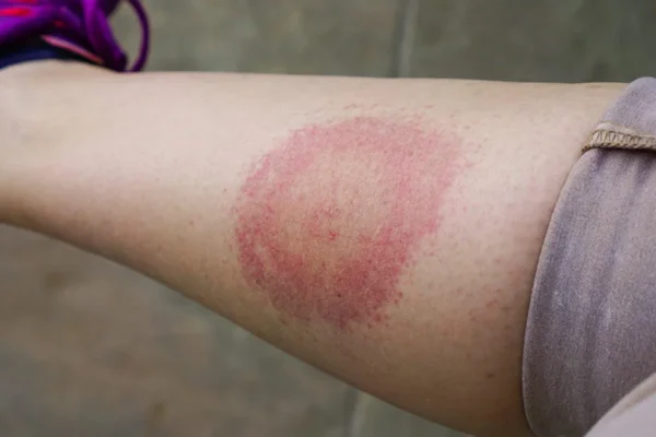 Tick Bite Disease Warning Signs