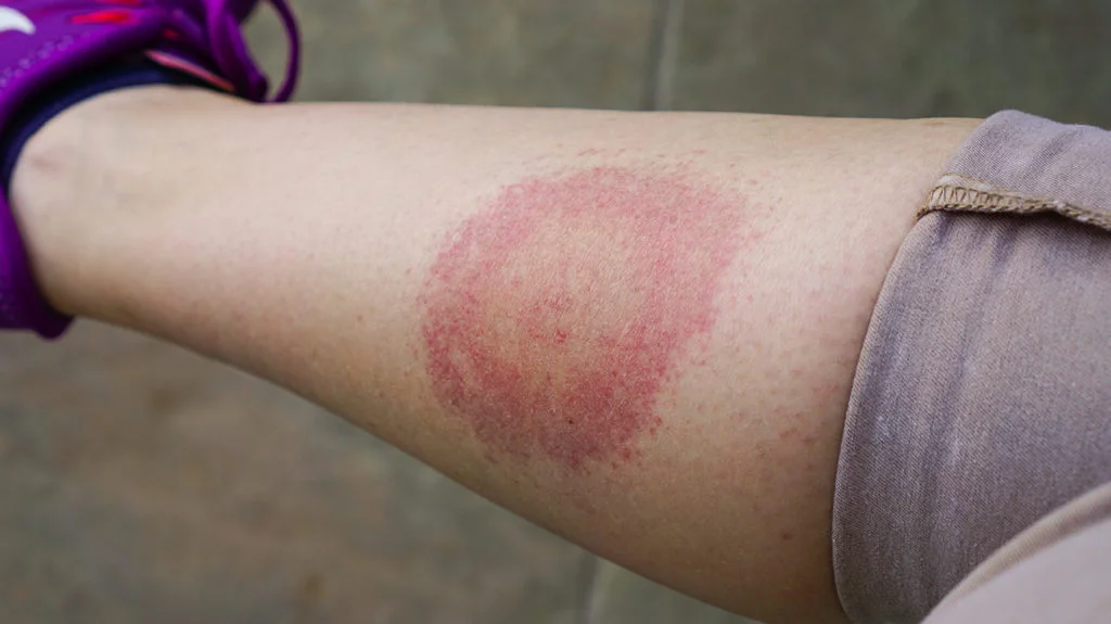 Tick Bite Disease Warning Signs