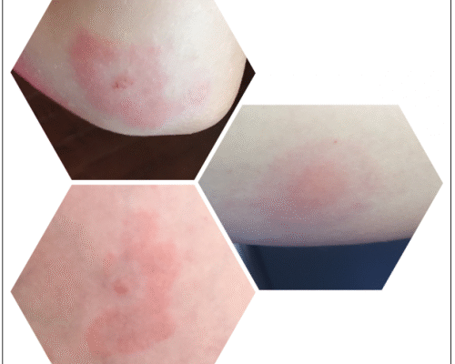 Tick Bite Rash Pictures: Identification, Symptoms, and Treatment Guide Tick Bite Rash Pictures