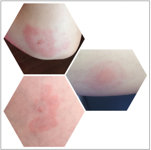 Tick Bite Rash Pictures