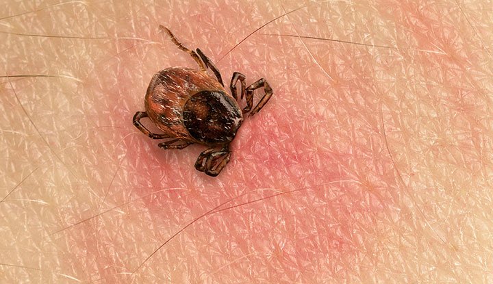Tick Bite Symptoms to Watch