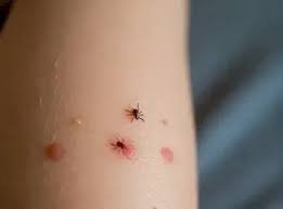 Tick Bite on Kids Treatment: A Complete Guide for Parents Tick Bite on Kids Treatment
