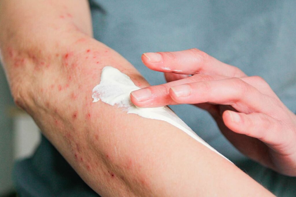 Treatment for Bed Bug Bites: Fast Relief & Skin Recovery Tips Treatment For Bed Bug Bites 1024x683