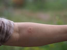 Wasp Sting Complications
