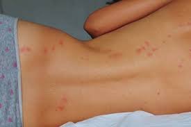 What Do Bed Bug Bites Look Like