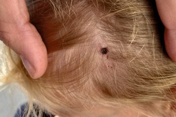 Where Do Ticks Usually Bite? Key Areas to Watch on Humans Where Do Ticks Usually Bite