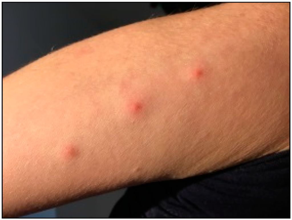 Bed Bug Bite Infection Signs You Shouldn’t Ignore: Symptoms, Risks & Treatment Bed Bug Bite Infection Signs You Shouldn’t Ignore