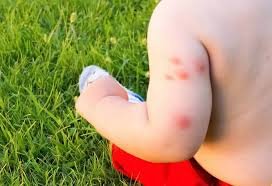 Bed Bug Bites on Children