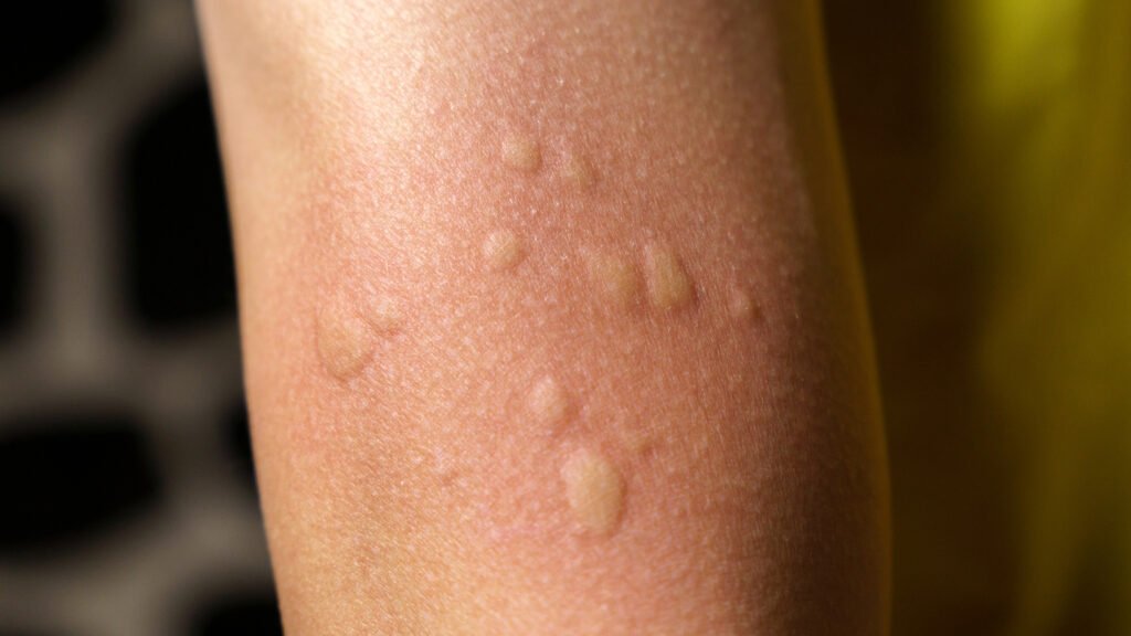 Bed Bug Rash vs. Allergic Reaction: Spot the Difference and Protect Your Skin Bed Bug Rash vs. Allergic Reaction
