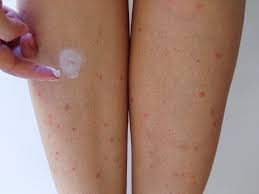 Mosquito Bite Treatment for Sensitive Skin