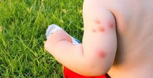 Mosquito Bites in Children