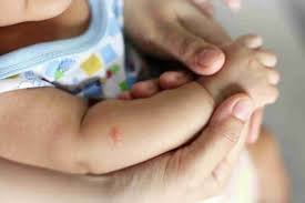 Mosquito Bites on Babies