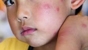 Mosquito Bites on Face