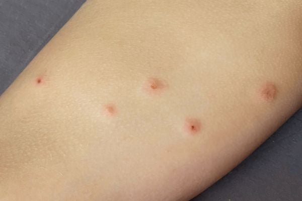How Long Do Bed Bug Bites Last on Skin